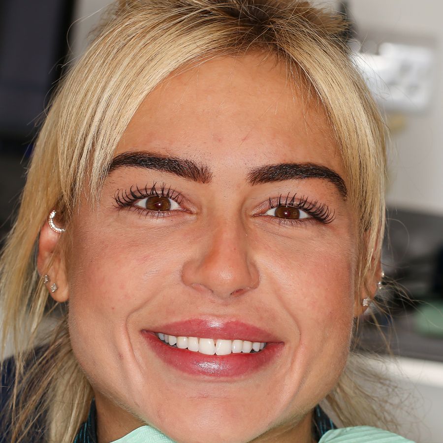 composite veneers before - 3dental